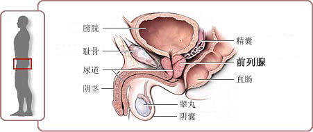 什么是前列腺病